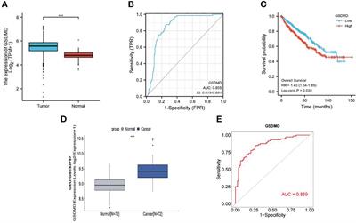 Expression of gasdermin D in clear cell renal cell carcinoma and its effect on its biological function